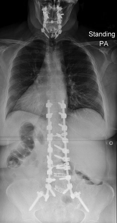 Image of abnormal postoperative thoracolumbar fusion